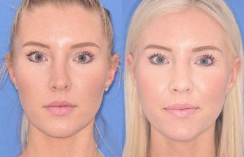 patient before and after rhinoplasty procedure