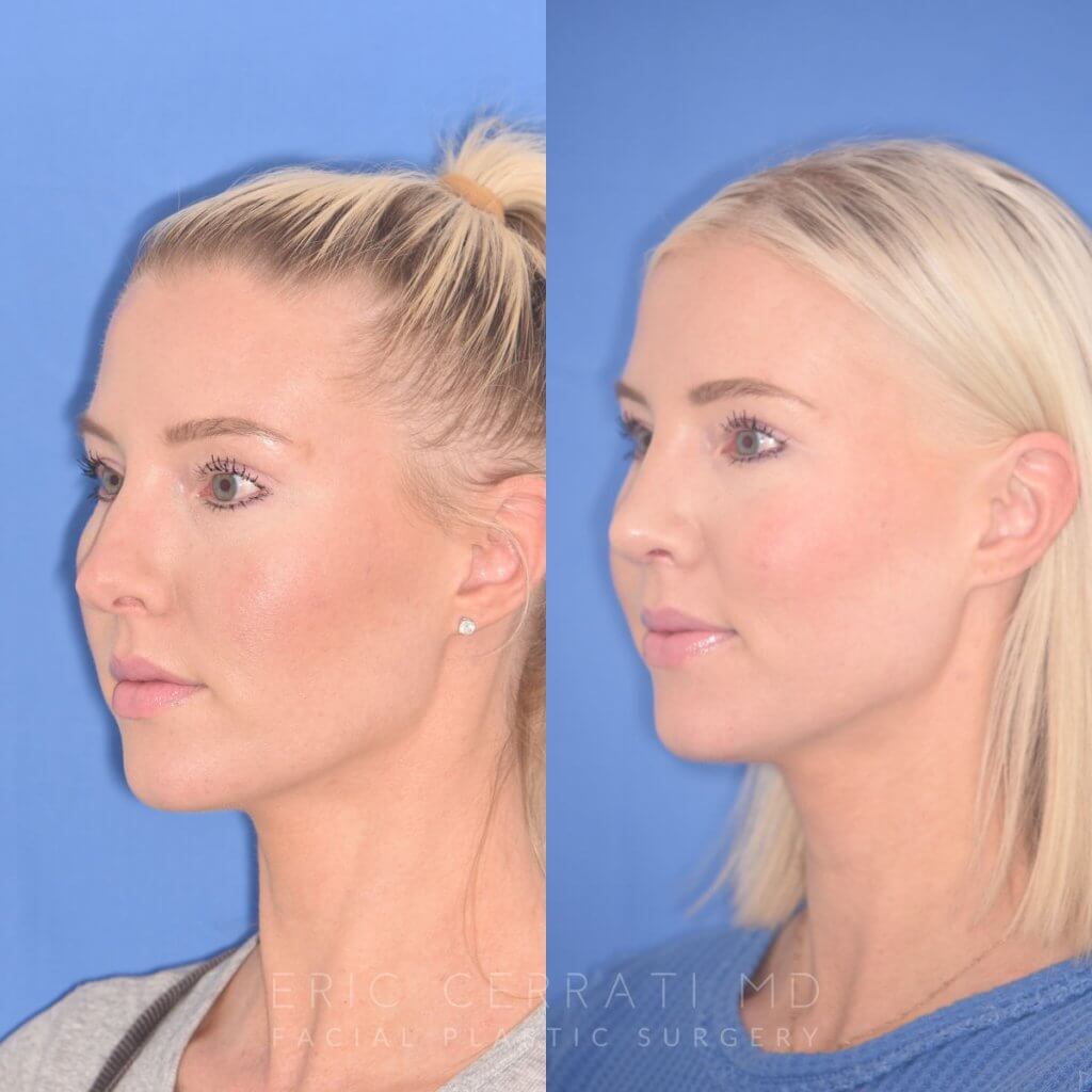 patient before and after rhinoplasty procedure