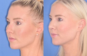 patient before and after rhinoplasty procedure