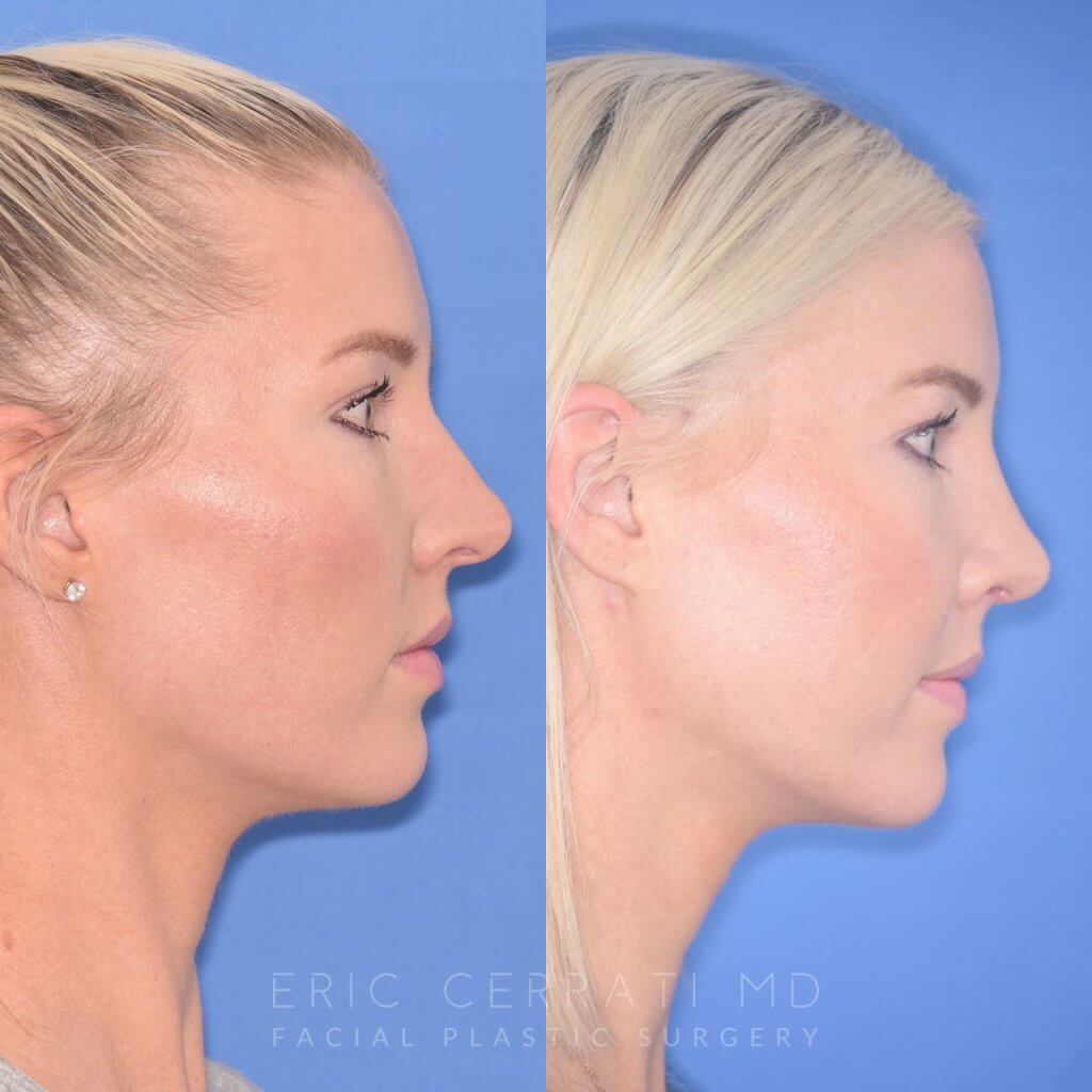 patient before and after rhinoplasty procedure