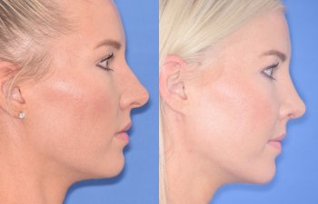 patient before and after rhinoplasty procedure