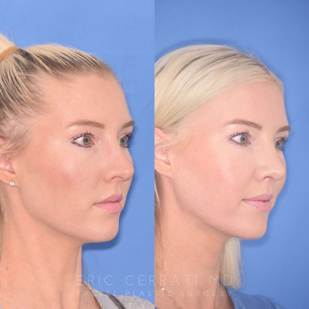 patient before and after rhinoplasty procedure