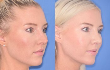 patient before and after rhinoplasty procedure