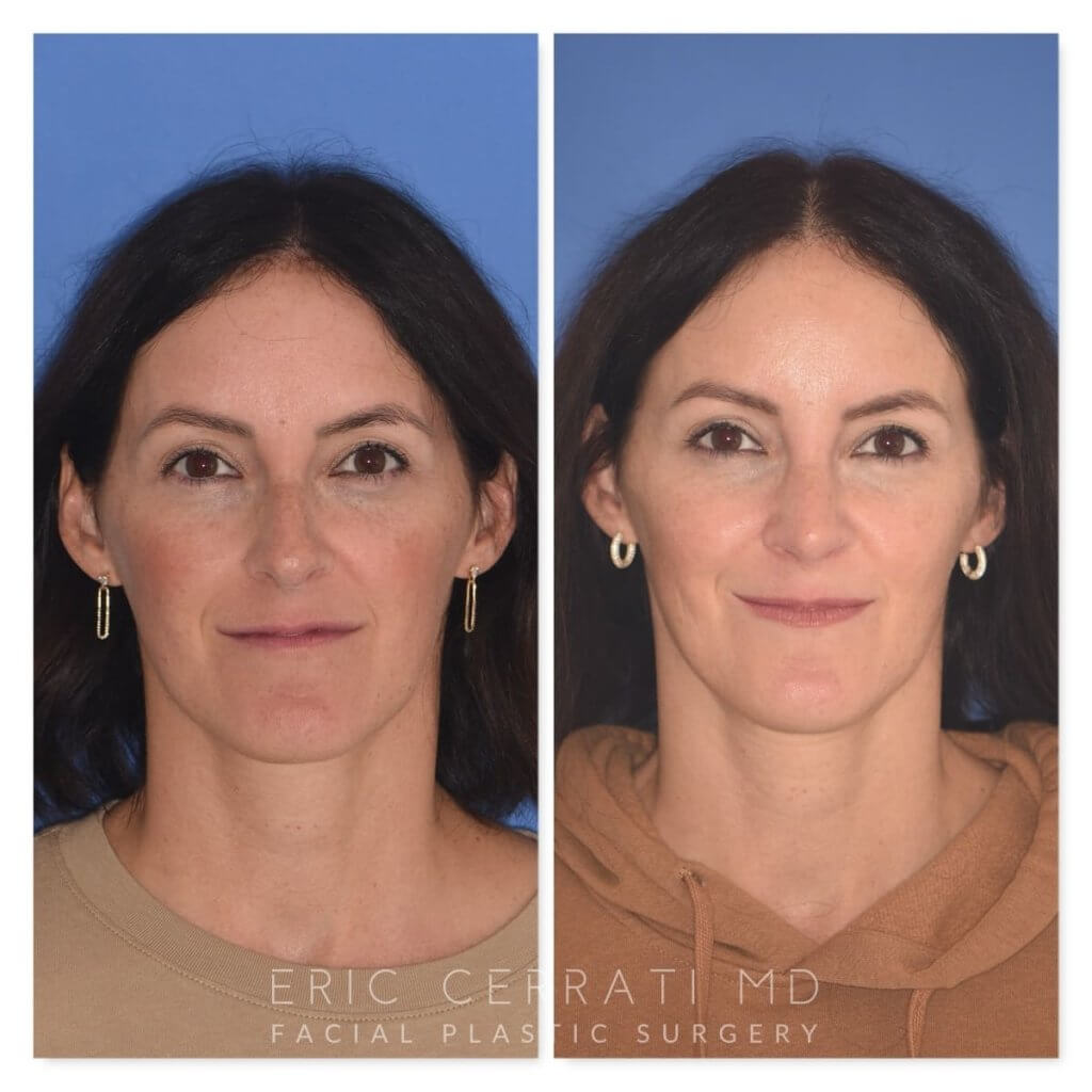 patient before and after rhinoplasty procedure