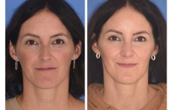 patient before and after rhinoplasty procedure