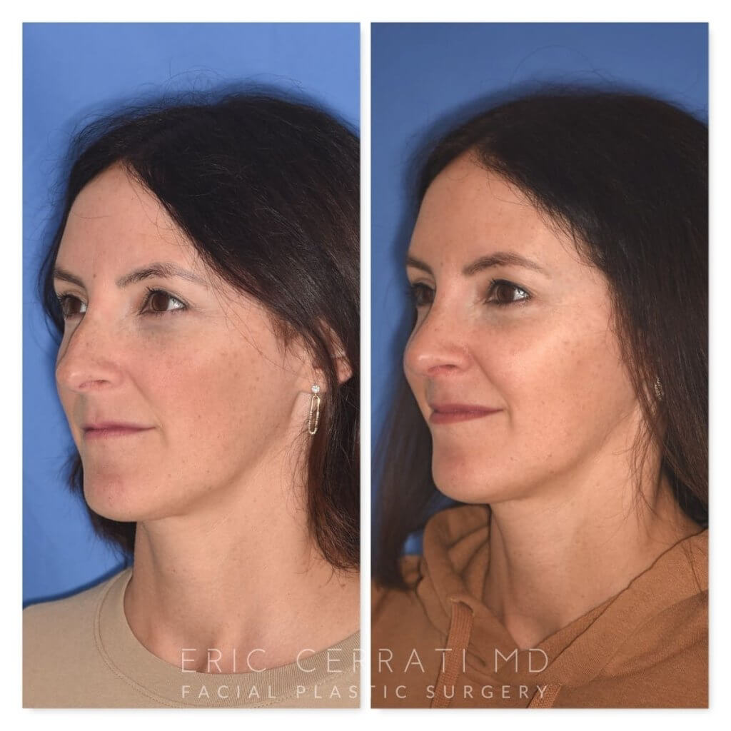patient before and after rhinoplasty procedure