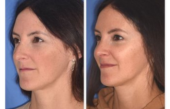 patient before and after rhinoplasty procedure