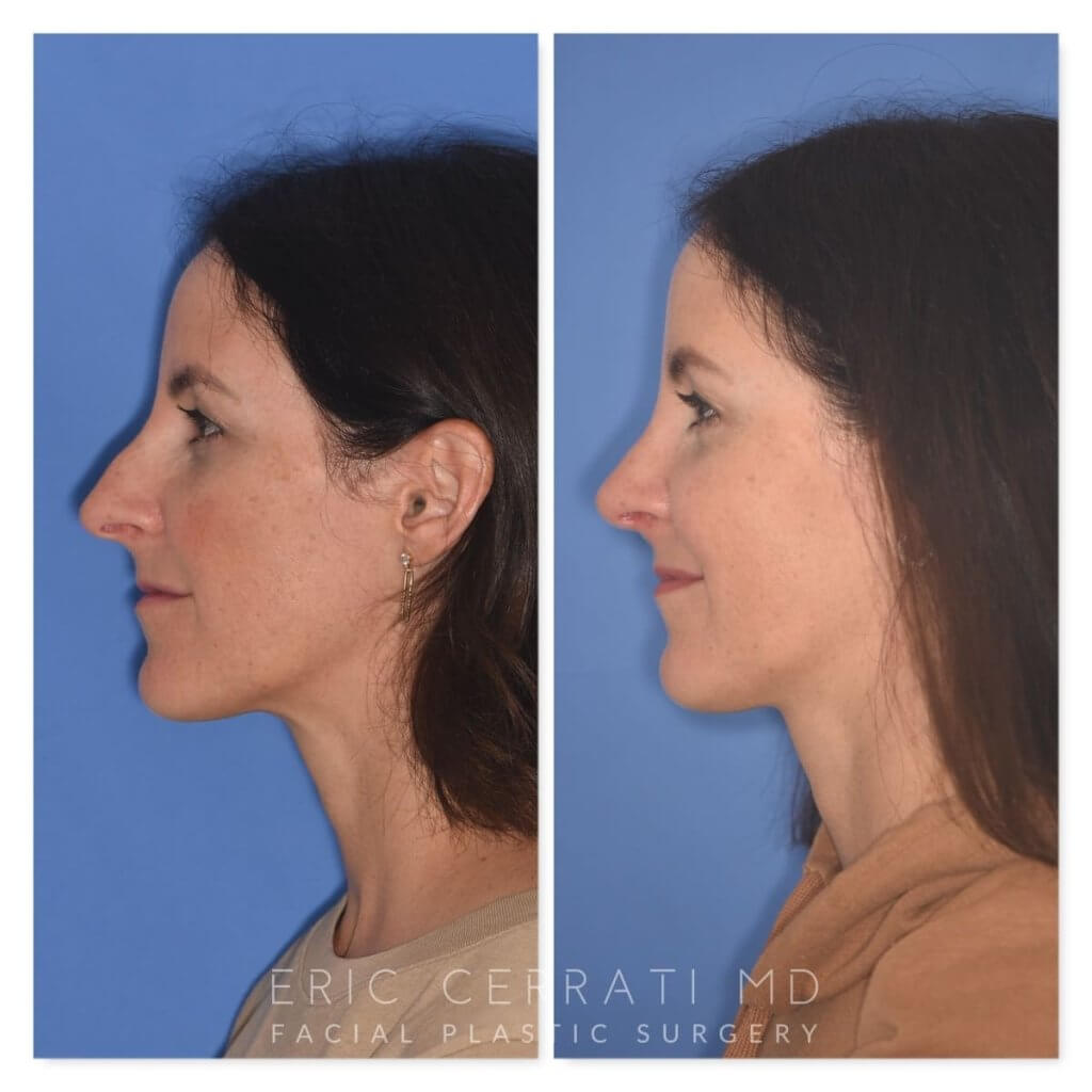 patient before and after rhinoplasty procedure