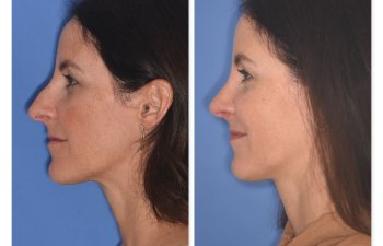 patient before and after rhinoplasty procedure