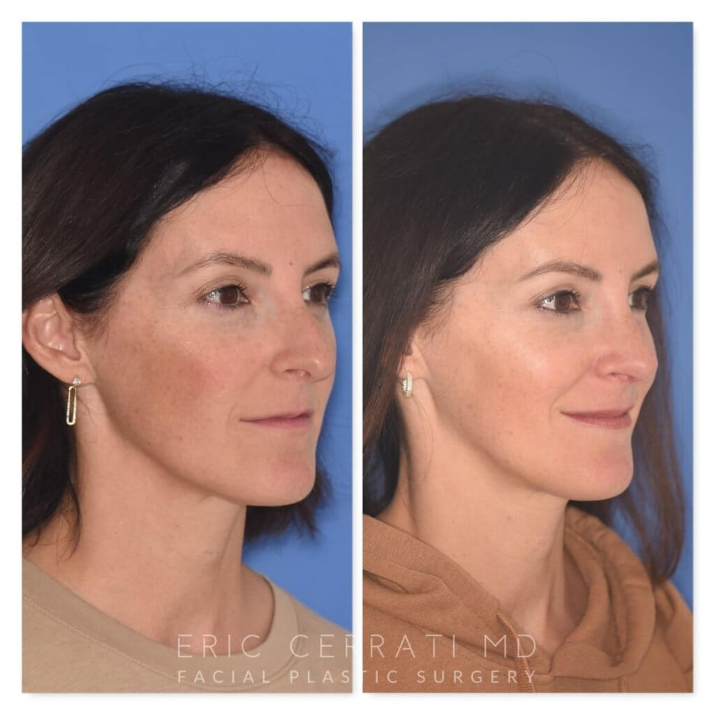 patient before and after rhinoplasty procedure