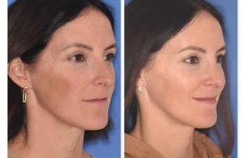 patient before and after rhinoplasty procedure