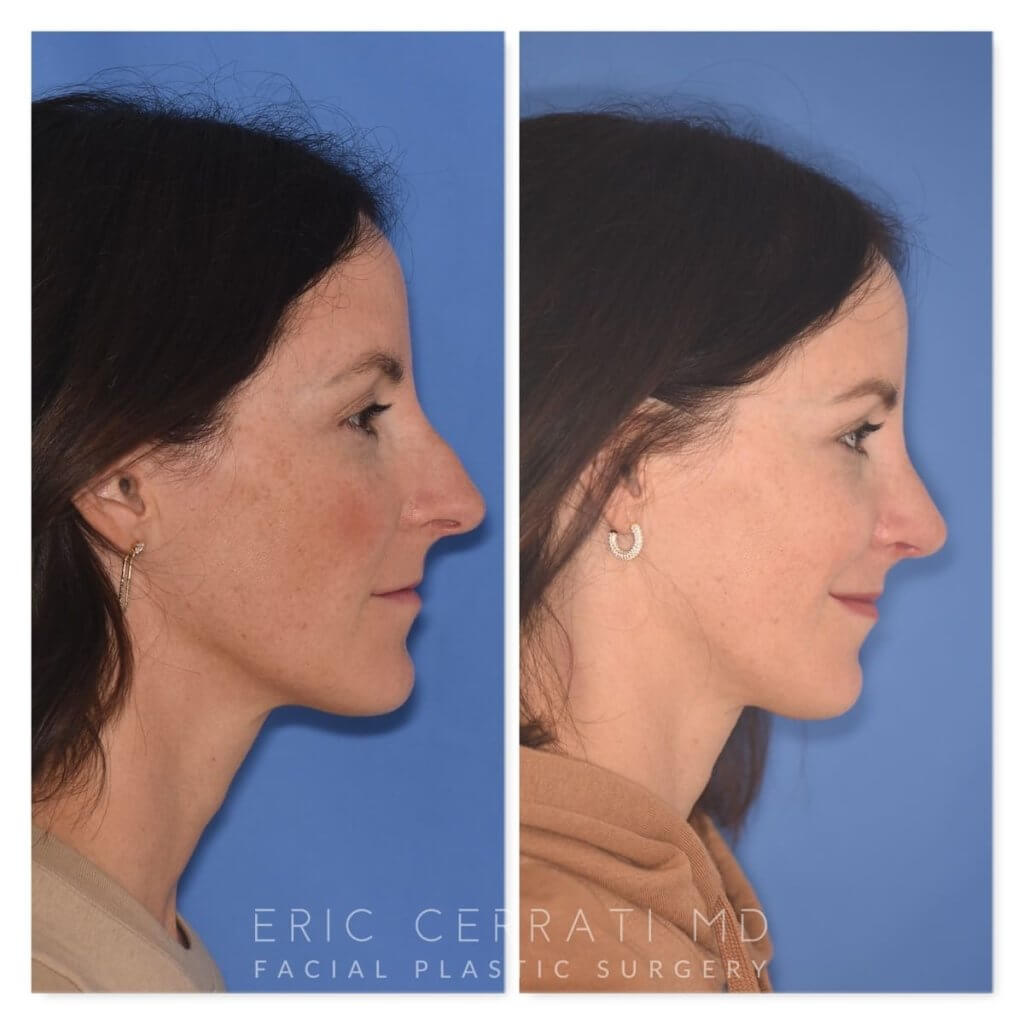 patient before and after rhinoplasty procedure