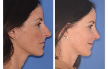 patient before and after rhinoplasty procedure