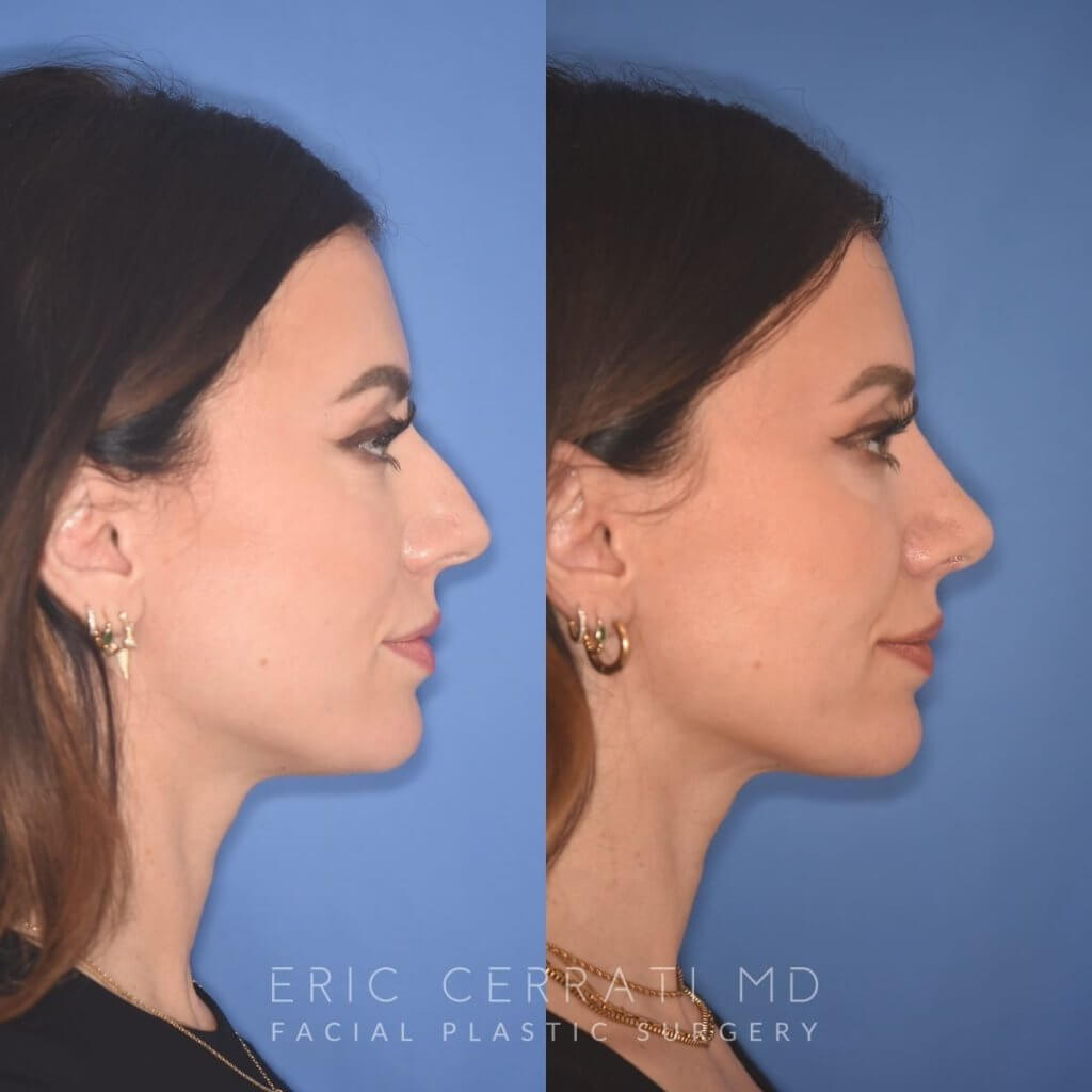 patient before and after rhinoplasty procedure