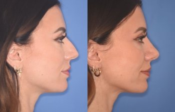 patient before and after rhinoplasty procedure