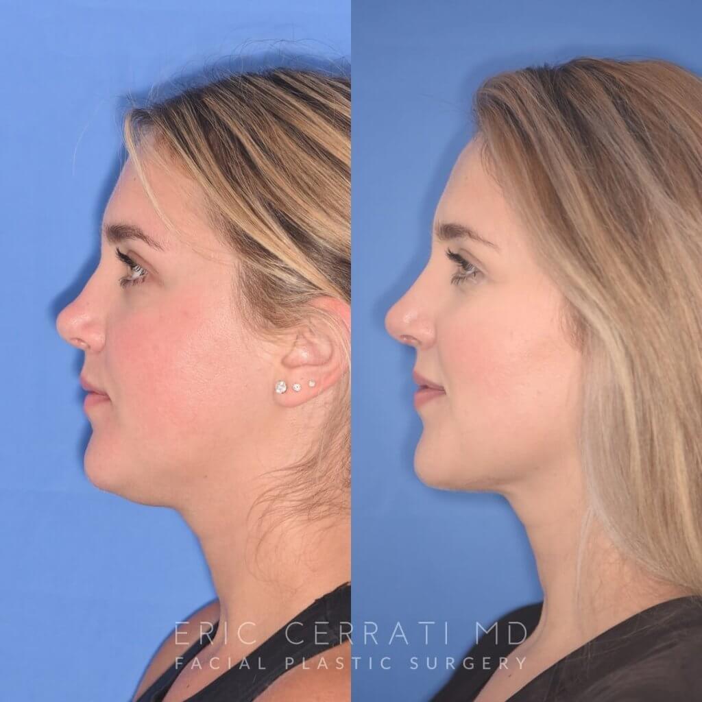 patient before and after revision rhinoplasty, buccal fat reduction and neck liposuction