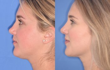 patient before and after revision rhinoplasty, buccal fat reduction and neck liposuction