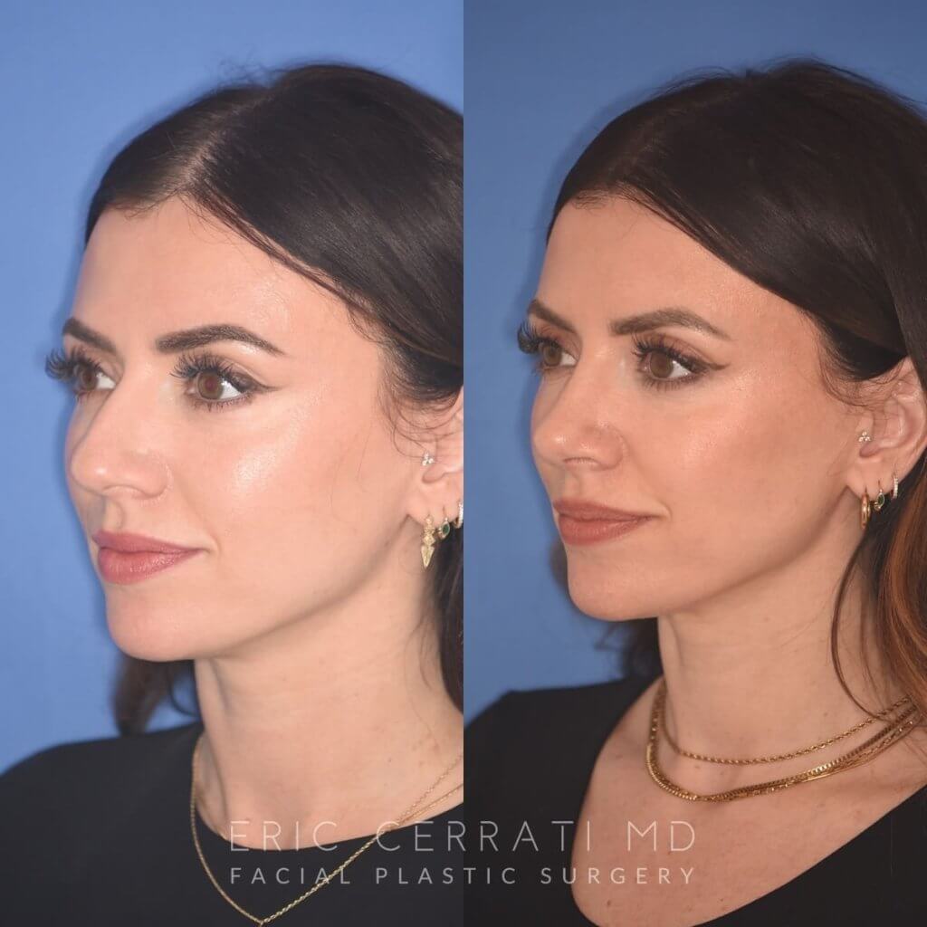 patient before and after rhinoplasty procedure