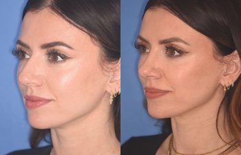 patient before and after rhinoplasty procedure