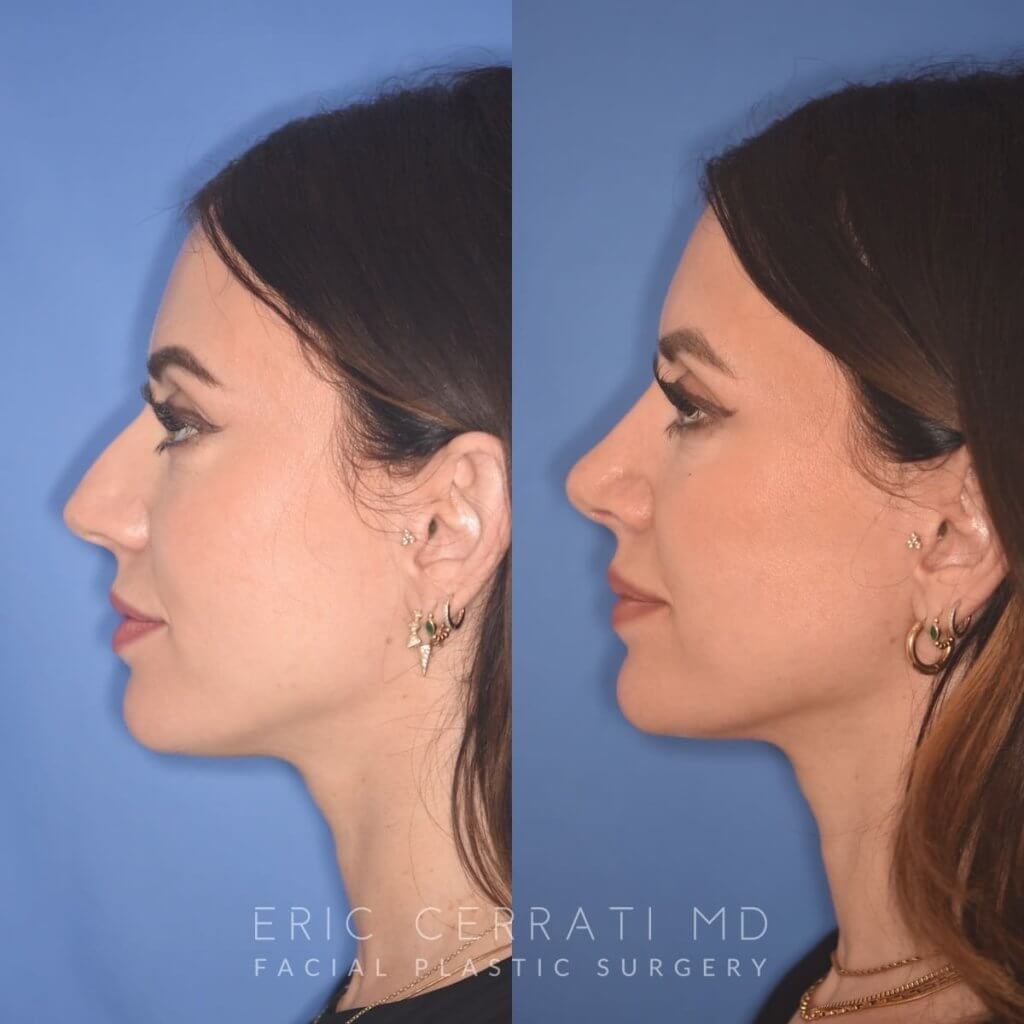patient before and after rhinoplasty procedure