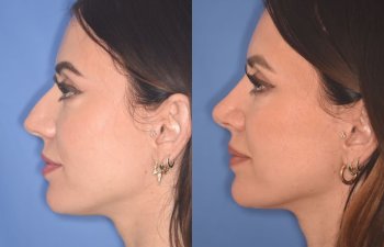 patient before and after rhinoplasty procedure