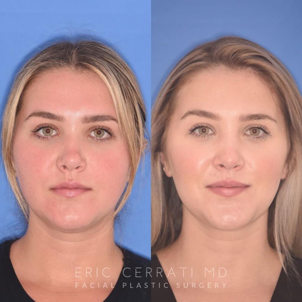 patient before and after revision rhinoplasty, buccal fat reduction and neck liposuction