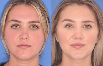 patient before and after revision rhinoplasty, buccal fat reduction and neck liposuction