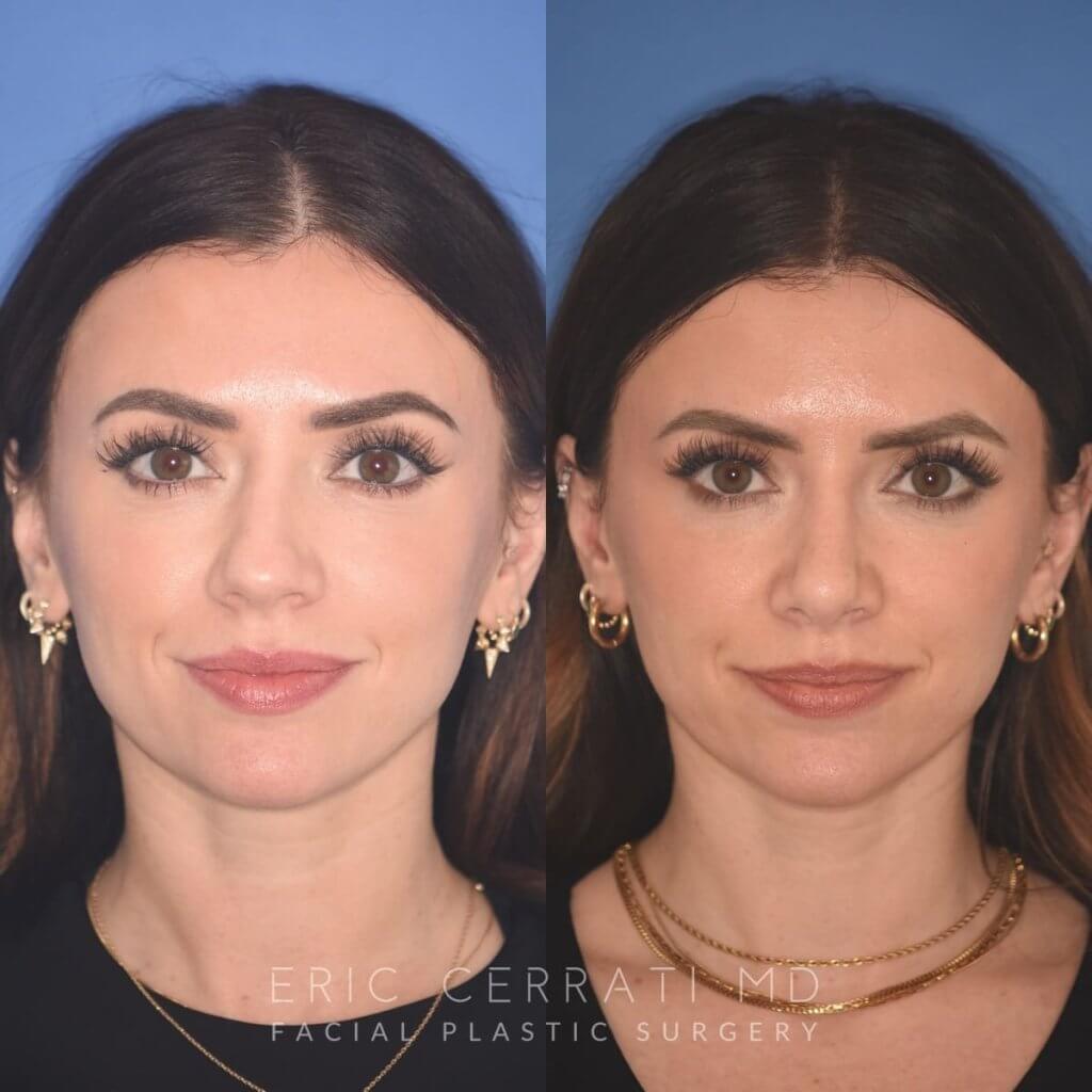 patient before and after rhinoplasty procedure