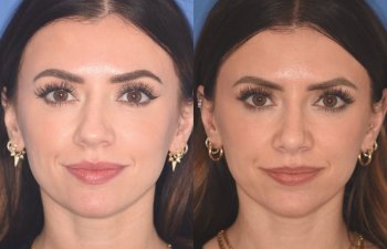 patient before and after rhinoplasty procedure