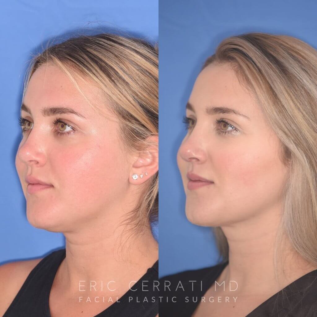 patient before and after revision rhinoplasty, buccal fat reduction and neck liposuction