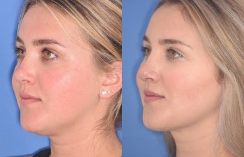 patient before and after revision rhinoplasty, buccal fat reduction and neck liposuction
