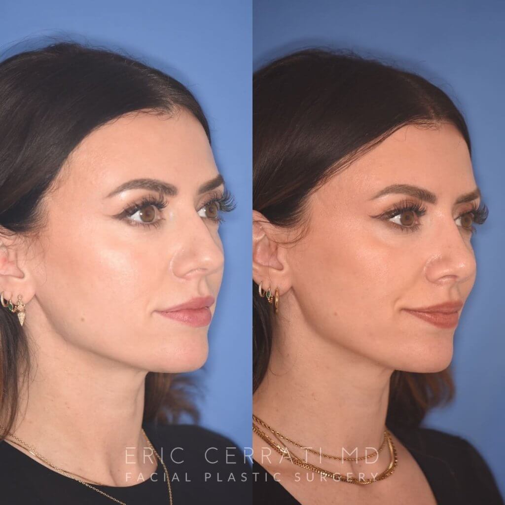 patient before and after rhinoplasty procedure