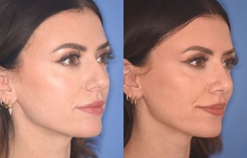 patient before and after rhinoplasty procedure