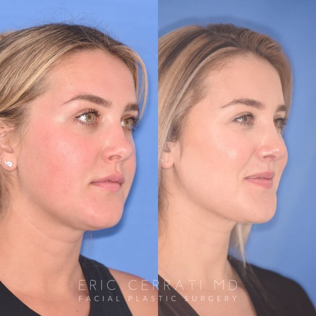 patient before and after revision rhinoplasty, buccal fat reduction and neck liposuction