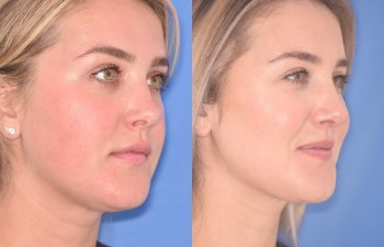 patient before and after revision rhinoplasty, buccal fat reduction and neck liposuction