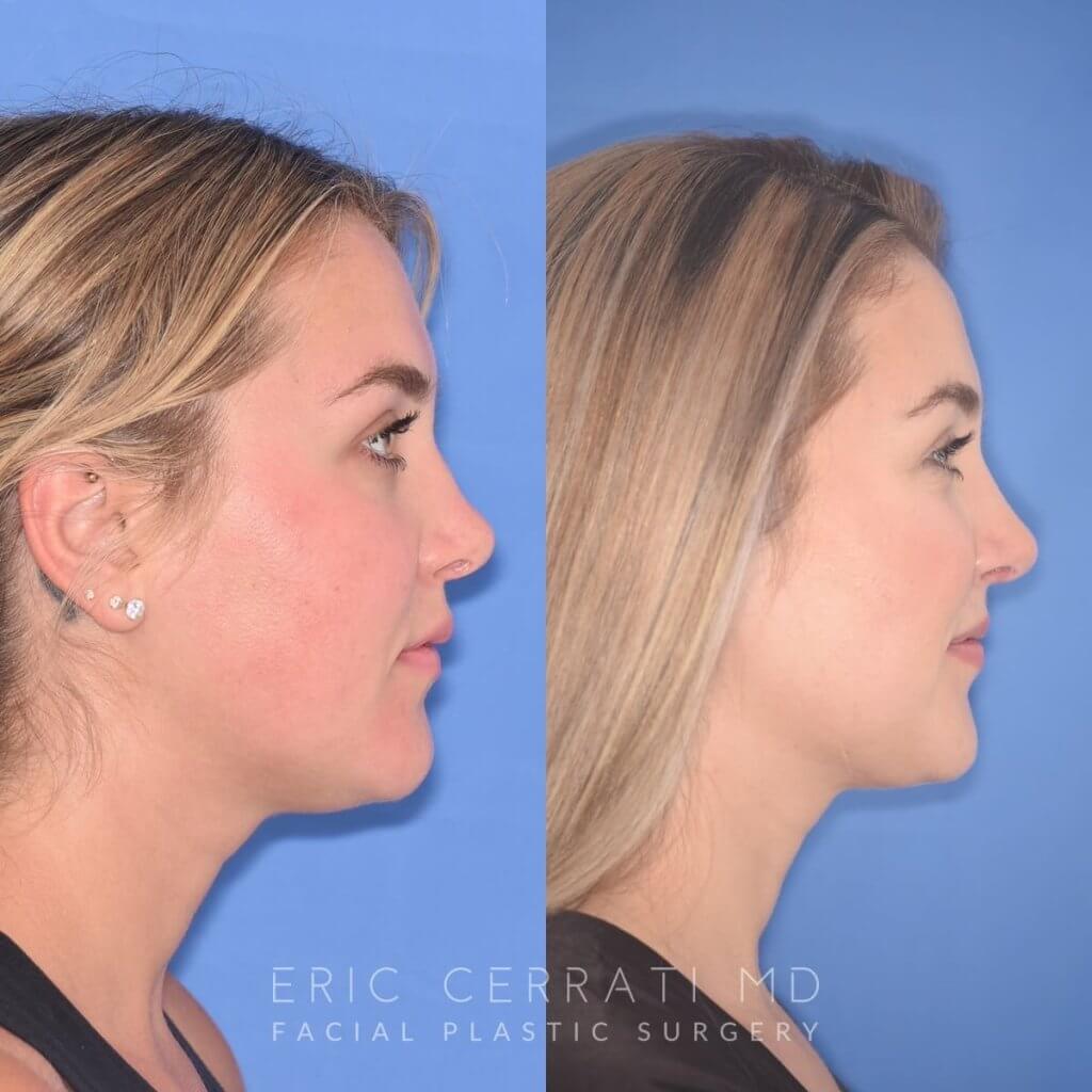 patient before and after revision rhinoplasty, buccal fat reduction and neck liposuction
