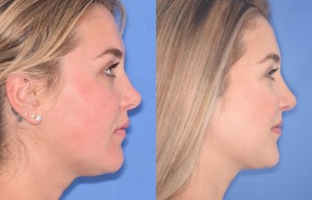 patient before and after revision rhinoplasty, buccal fat reduction and neck liposuction