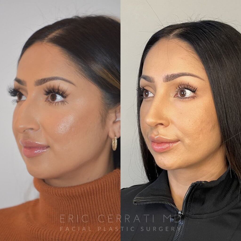 patient before and after rhinoplasty procedure