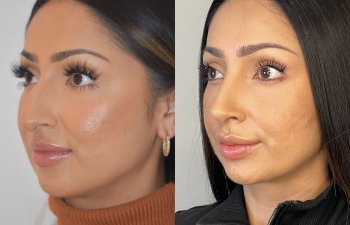 patient before and after rhinoplasty procedure