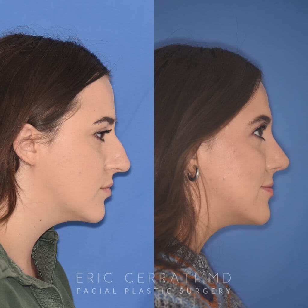 patient before and after rhinoplasty procedure