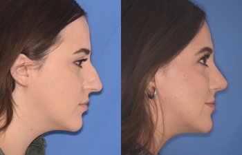 patient before and after rhinoplasty procedure