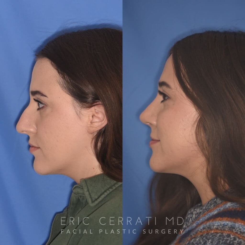 patient before and after rhinoplasty procedure
