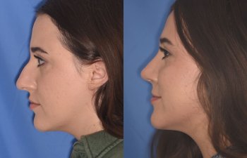 patient before and after rhinoplasty procedure