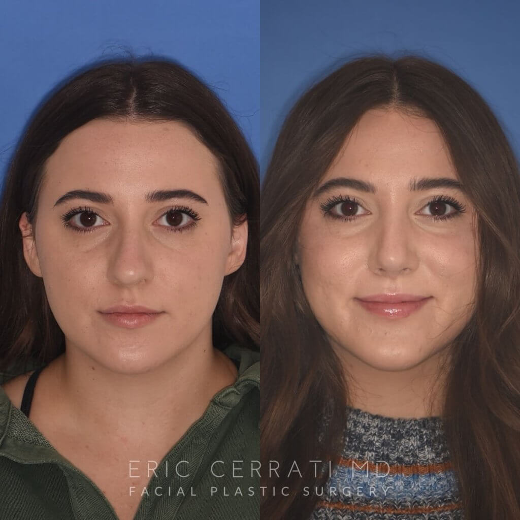 patient before and after rhinoplasty procedure