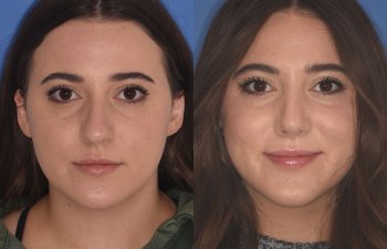 patient before and after rhinoplasty procedure