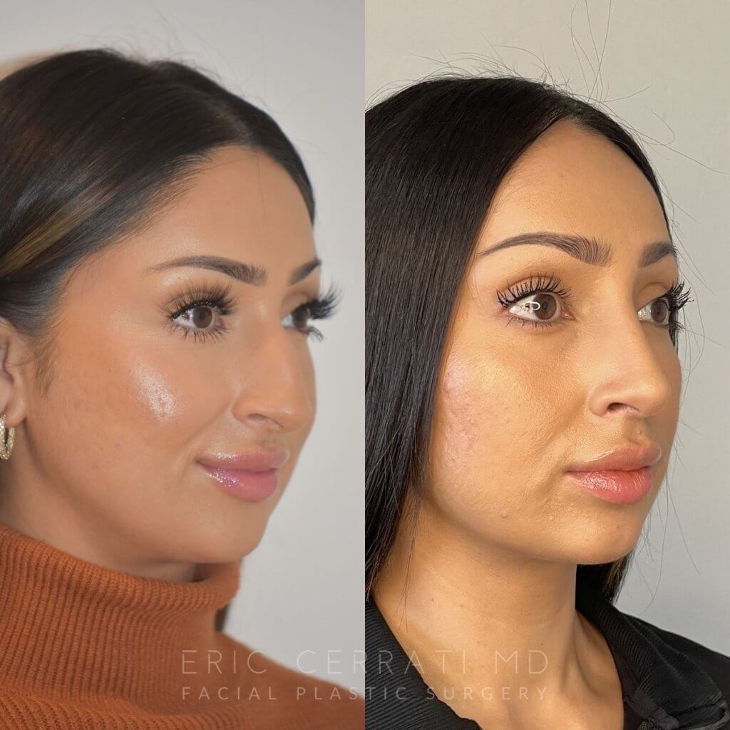 patient before and after rhinoplasty procedure