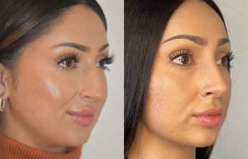 patient before and after rhinoplasty procedure