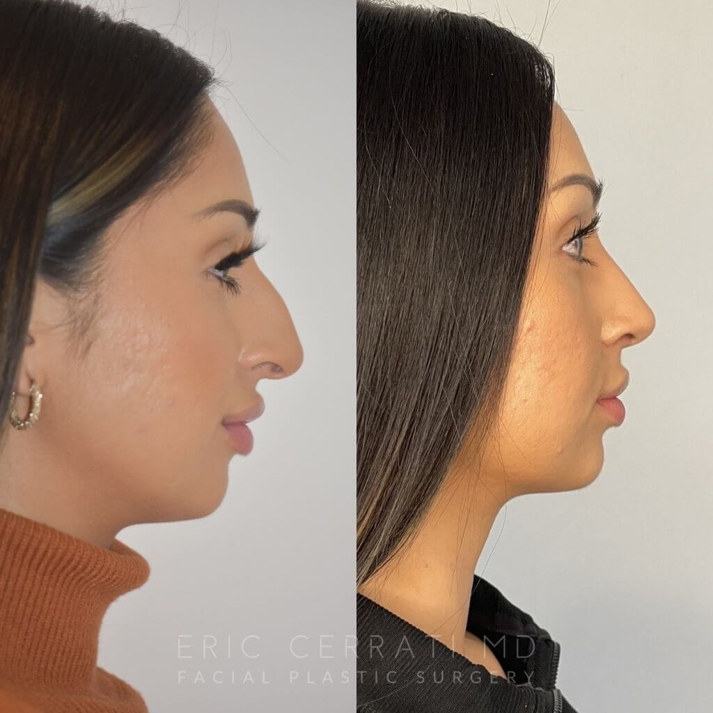 patient before and after rhinoplasty procedure