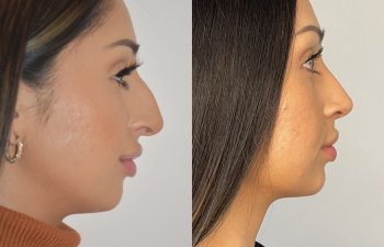 patient before and after rhinoplasty procedure