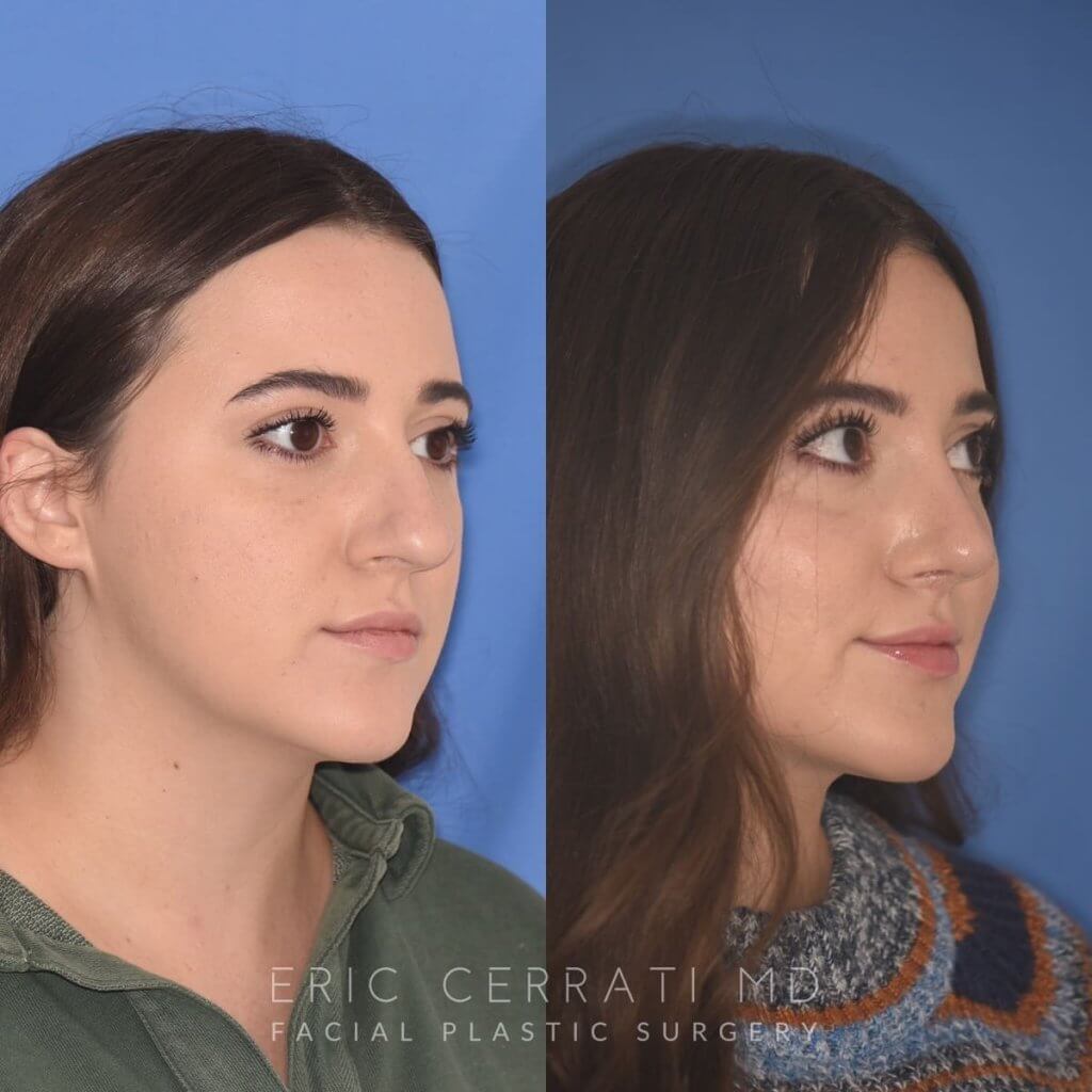 patient before and after rhinoplasty procedure
